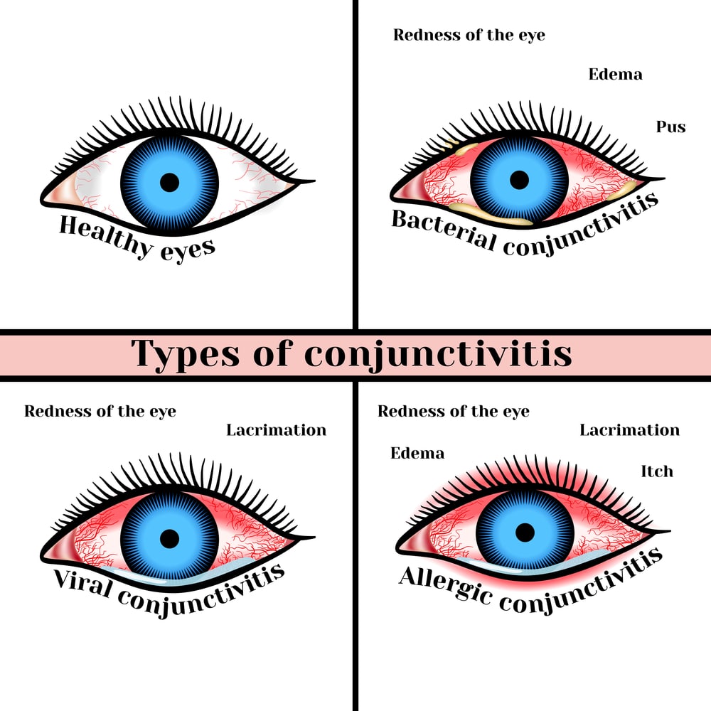 conjunctivitis treatment nj