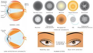 Cataract and its classifications