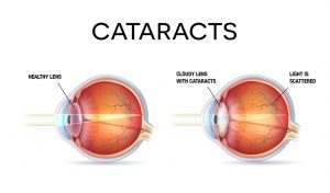 Cataract eye