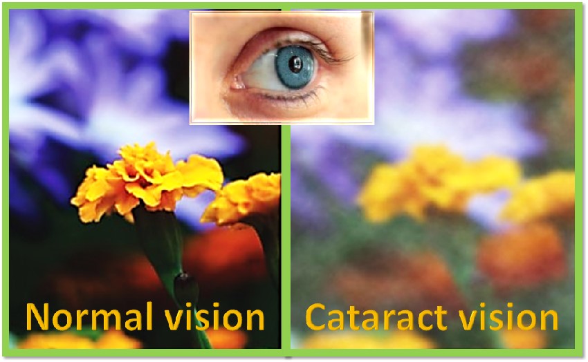 cataract vision