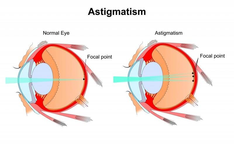 ASTIGMATISM