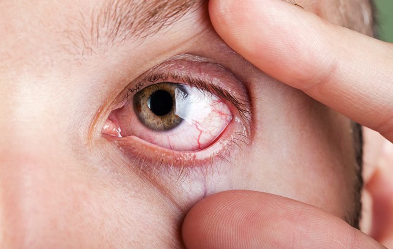 Dry Eye and Contact Lenses