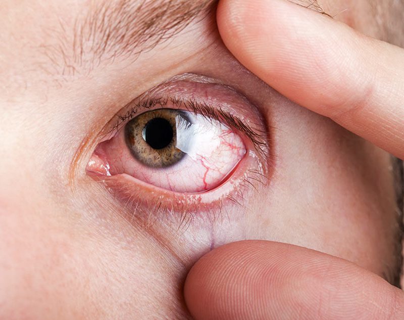 Dry Eye and Contact Lenses