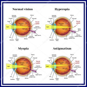 Refractive errors eyeball