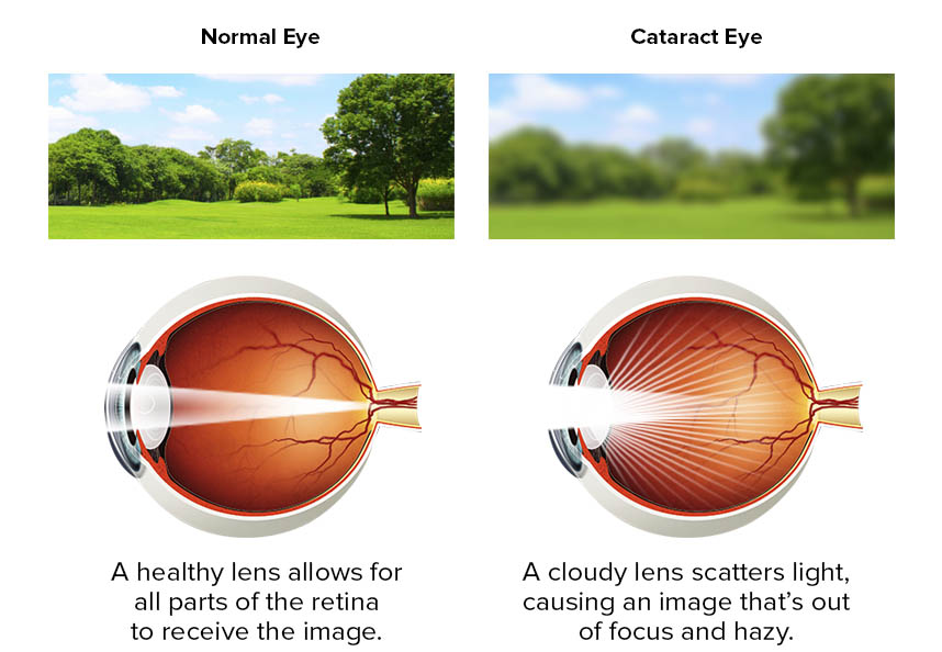 cataract