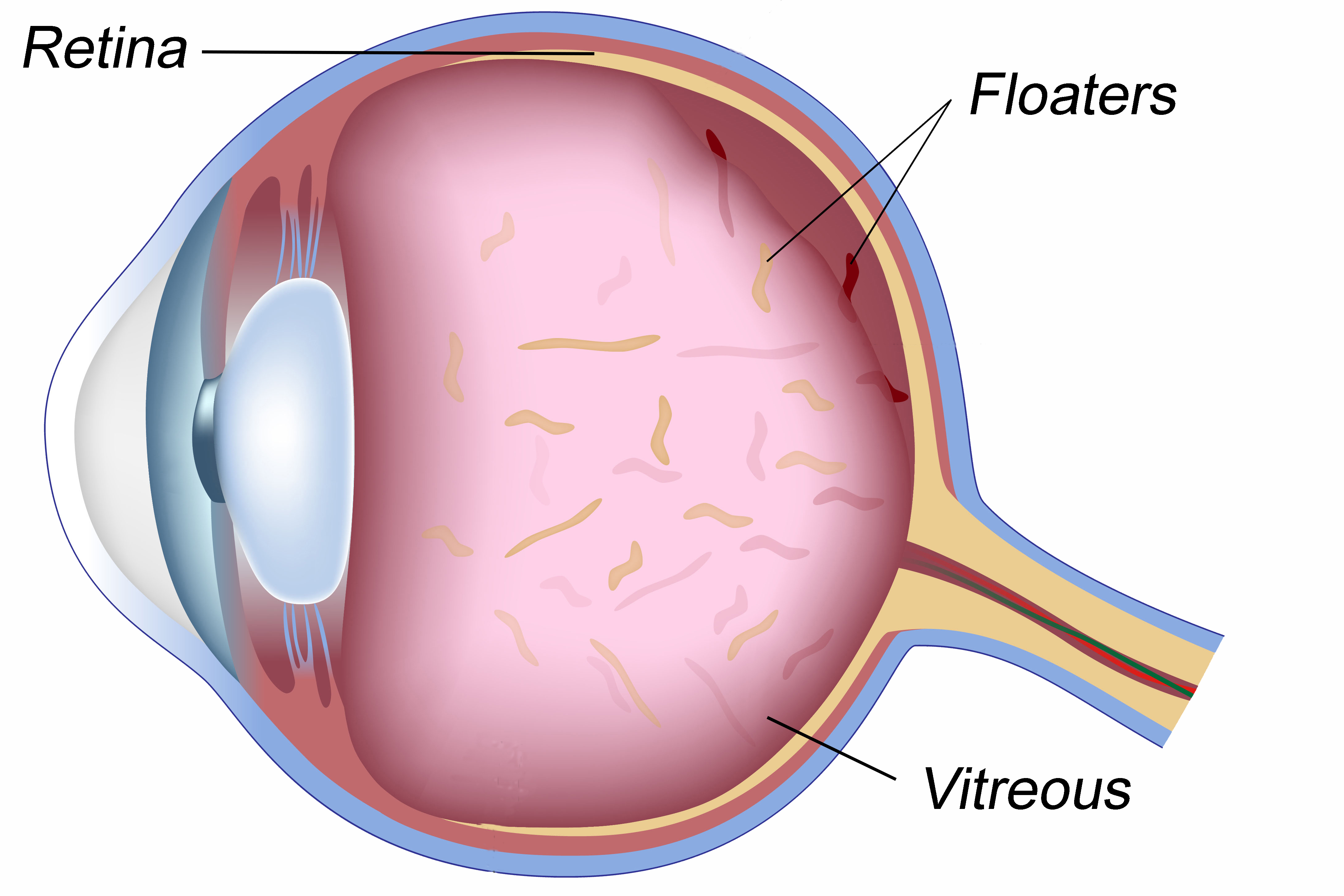 new research eye floaters