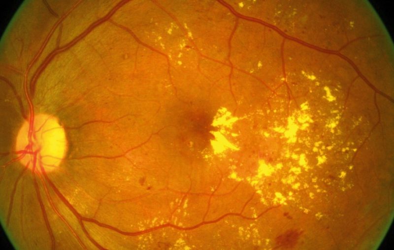 Age related macular degeneration