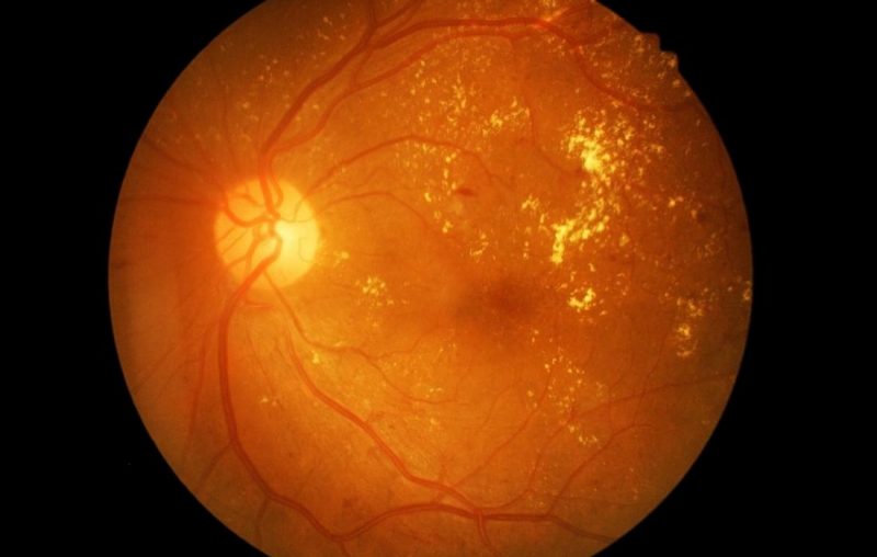 diabetic retinopathy