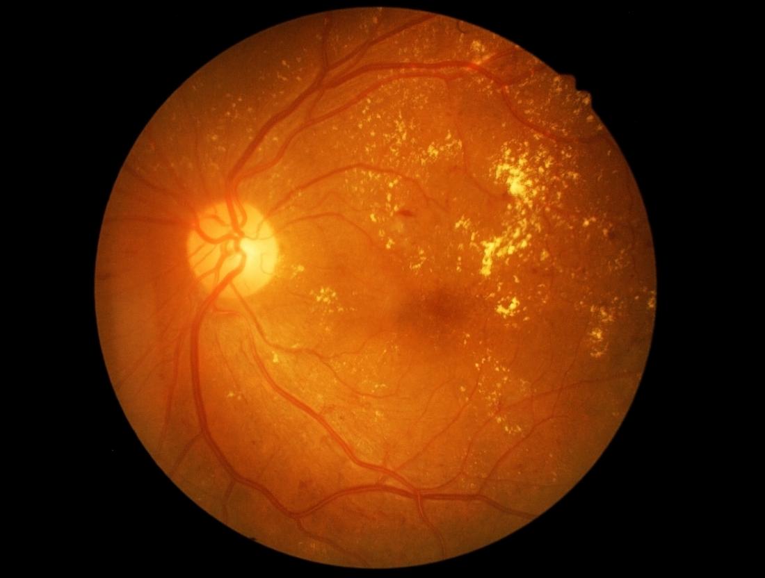 diabetic retinopathy