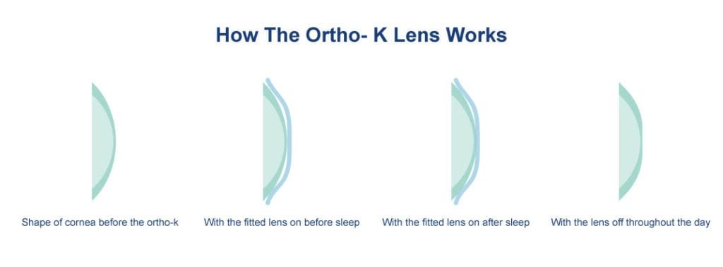 HOW ORTHO K WORKS