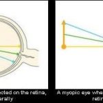 Myovision Normal vs Myopic1