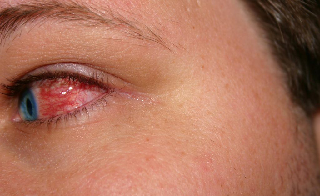 Red and Dry Eyes