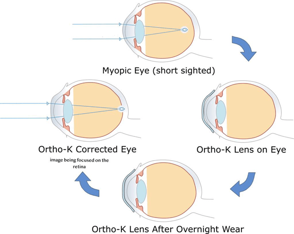 Corneal reshaping with Ortho-K lenses in overnight