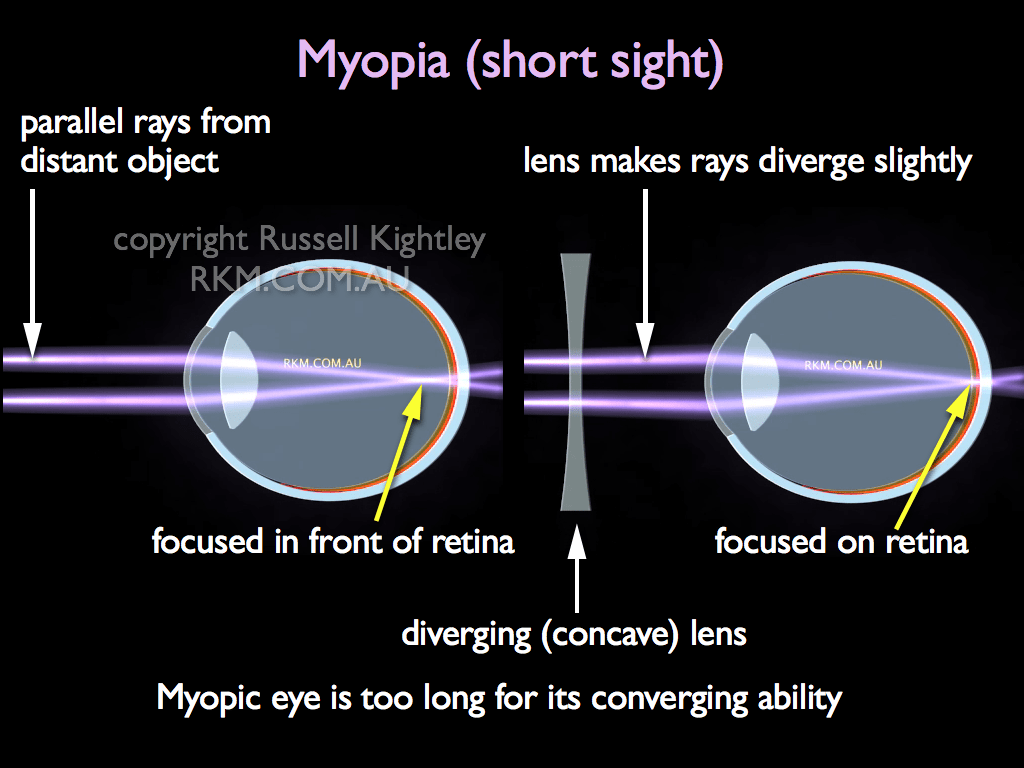 Eyes with short-sightedness 