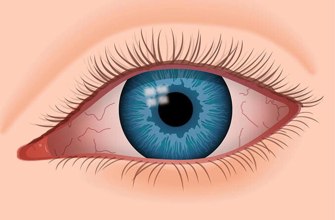 Redness in the eye due to dry eye