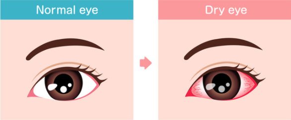 Normal Eye vs Dry Eye