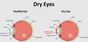 Healthy eye vs Dry Eye