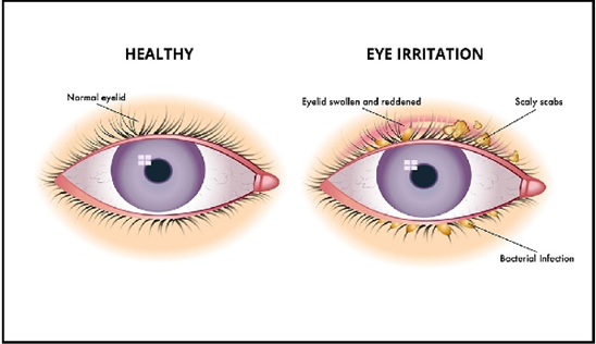 The differences of healthy eyes and irritation eyes (the effect of contact lens)