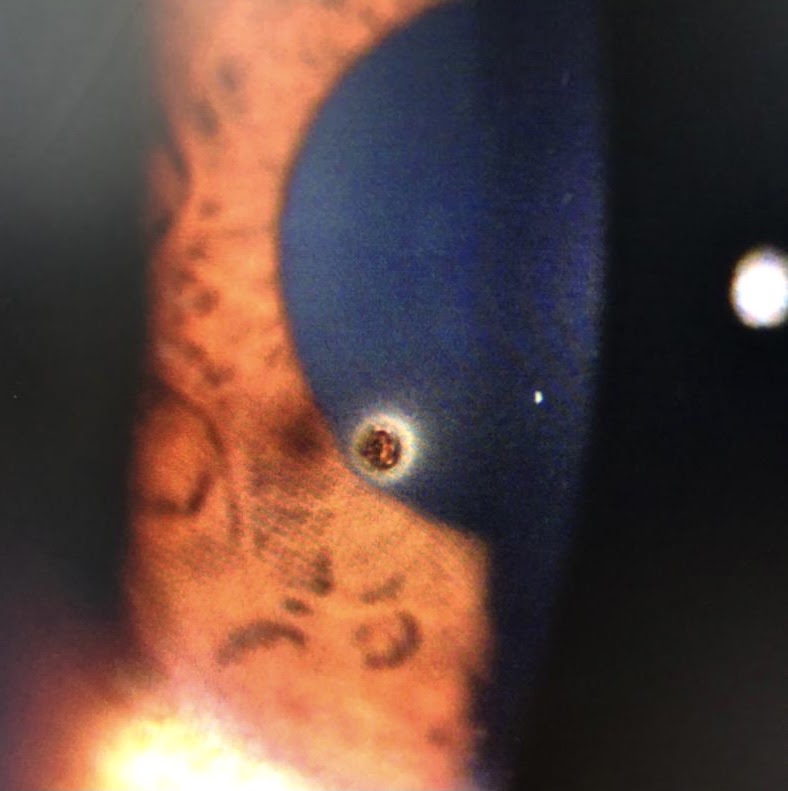 foreign object in eye