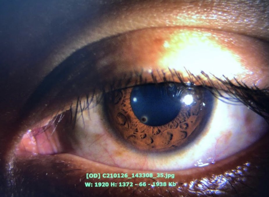 Foreign object in eye