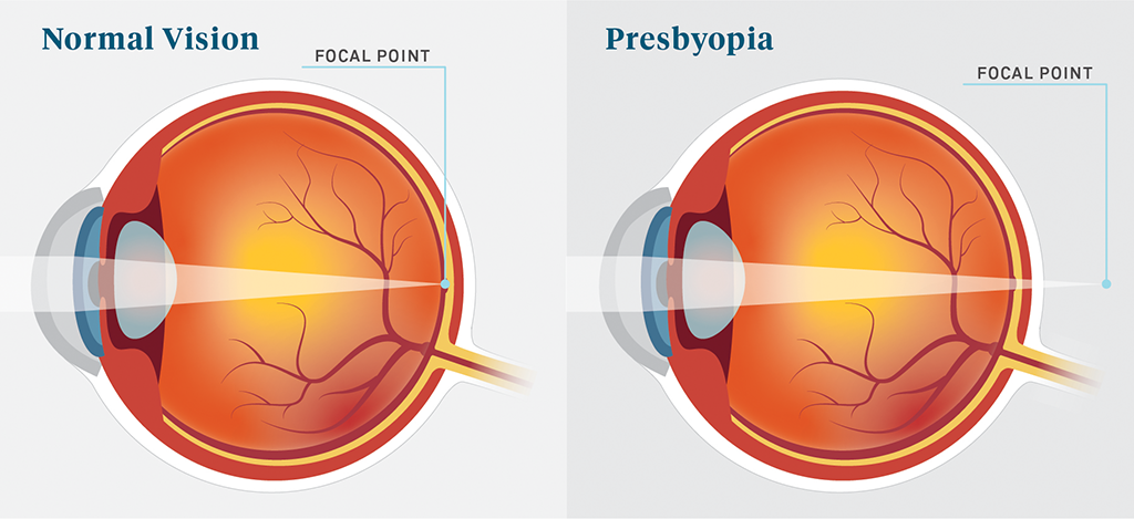 PureVision2 Multifocal contact lens