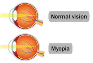 Myopia