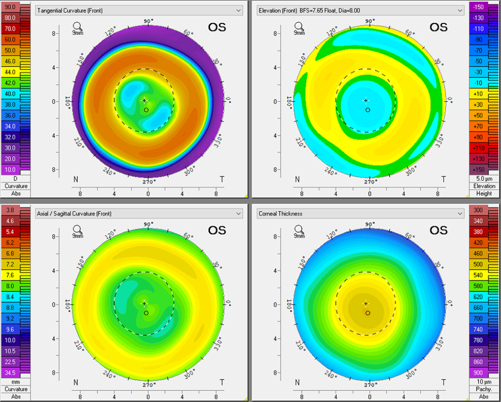 Myopia Treatment with Ortho K Lenses in Malaysia OK Lens in Malaysia
