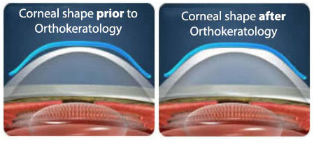 orthokeratology