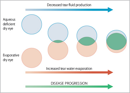 Evaporation and aqueous deficient dry eyes