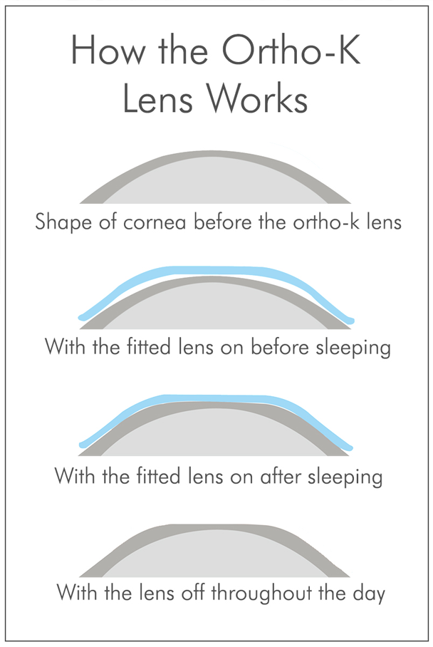 iSee Orthokeratology Contact Lens