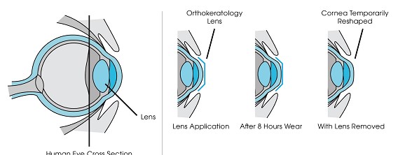 Eclid Orthokeratology Lens effect