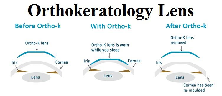 Euclid Orthokeratology near me