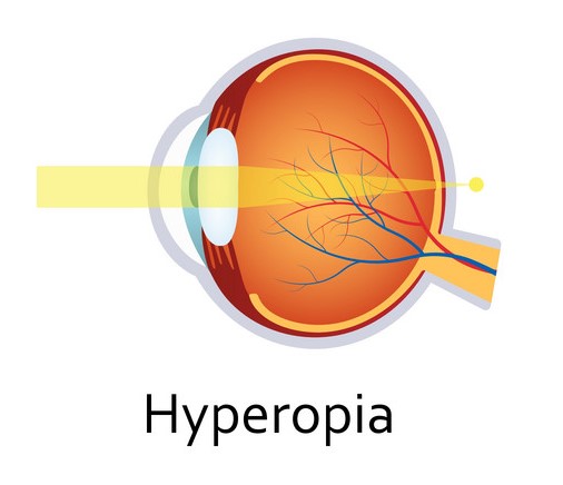Hyperopia