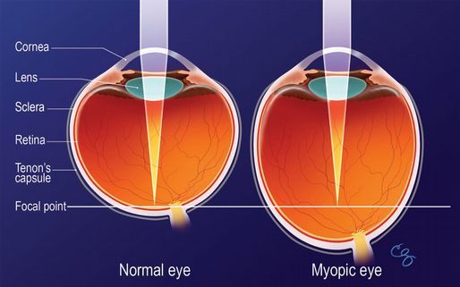 Eyeglasses frame - how to choose the right one for me?