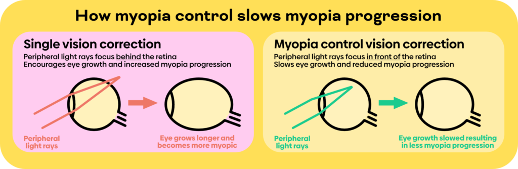 Myopia Control lenses near ne 