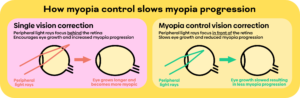 Myopia Control lenses near ne