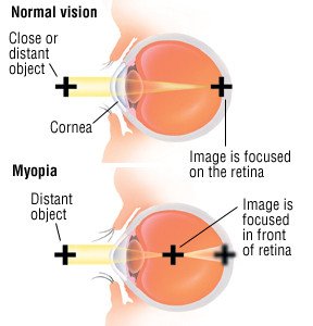 Myopia Control in Malaysia