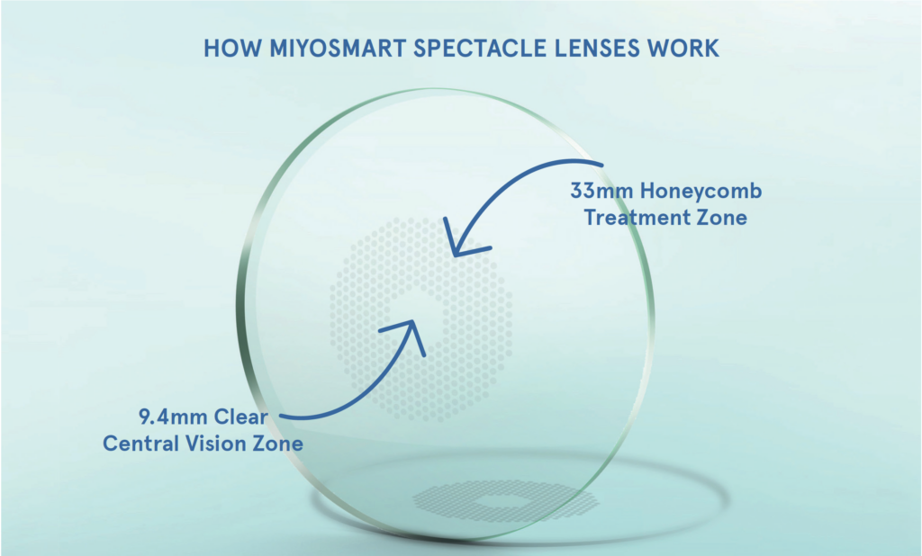 Are MiyoSmart Lenses Best for Myopic Children?