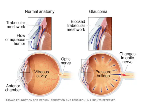 Glaucoma and vision loss
