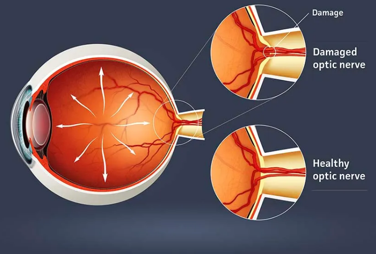 Glaucoma and vision loss