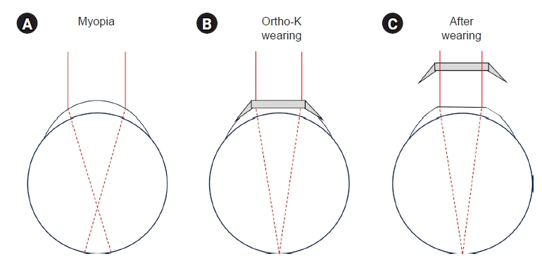 Mechanism of Ortho k to slow down the progression of myopia