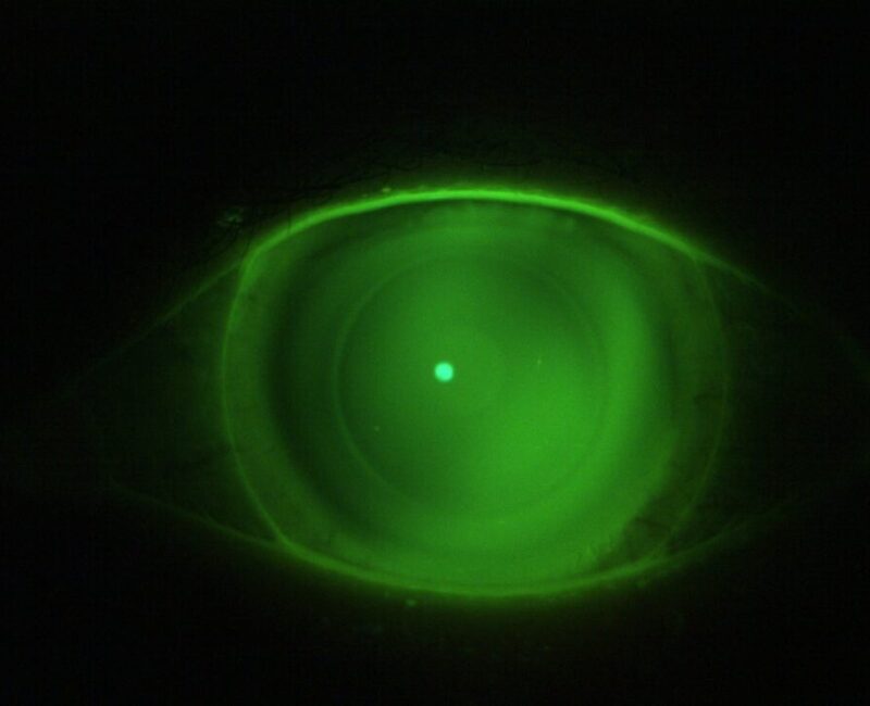 Actual photo of our patient with dry eyes disease fitted with semi scleral lenses.