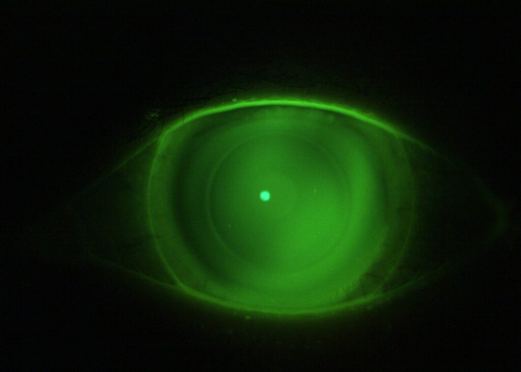 Actual photo of our patient with dry eyes disease fitted with semi scleral lenses.
