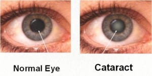 cataract screening