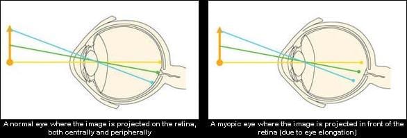 myovision