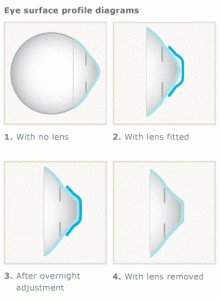 Ortho K | CRT | Corneal Refractive Theraphy